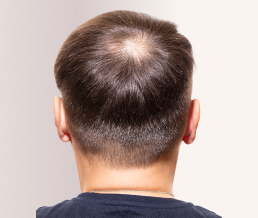 Лечение алопеции (выпадения волос)