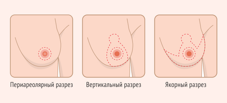 Три основные техники мастопексии
