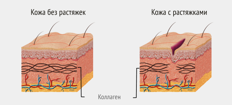 Иллюстрация кожи без растяжек (слева) и с растяжками (справа)